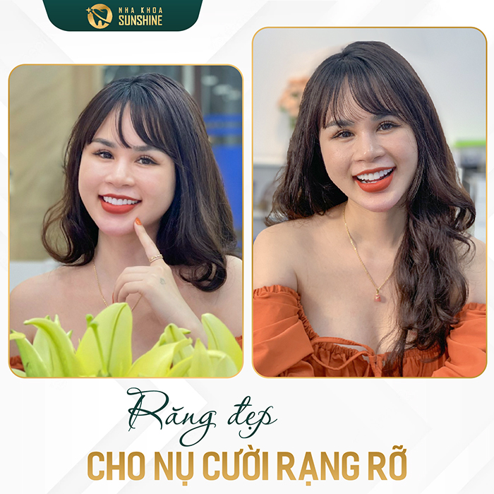 Bọc Răng Sứ