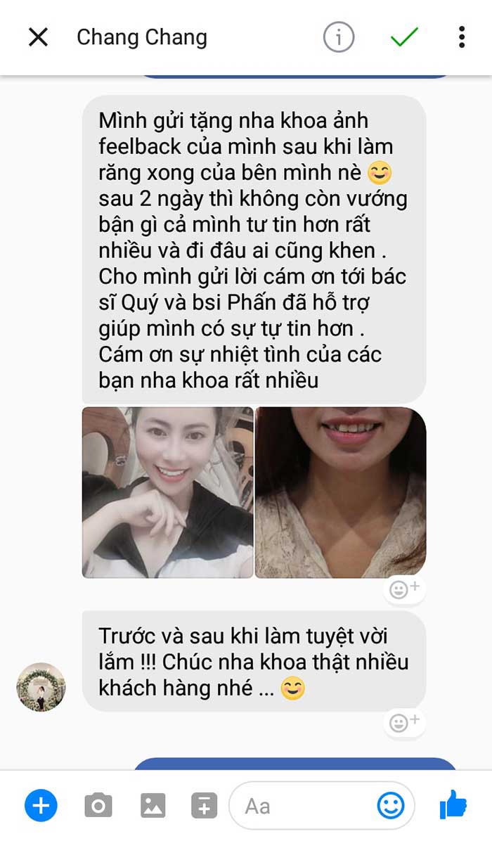 review bọc răng sứ