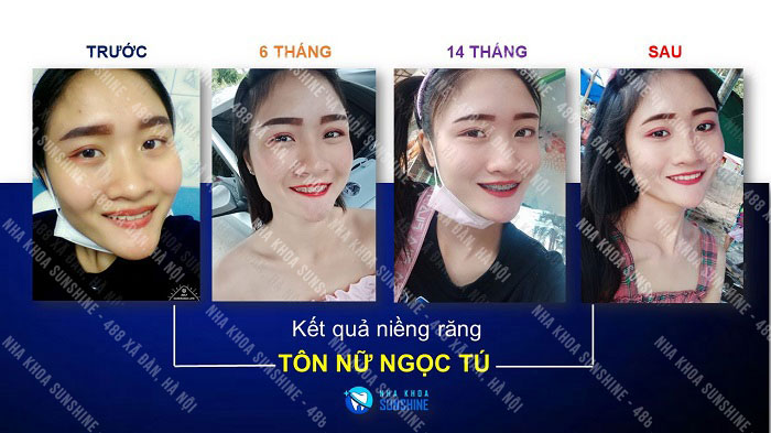 niềng răng niềng răng