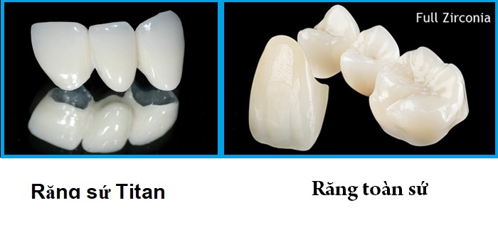 bọc răng sứ vita giá bao nhiêu