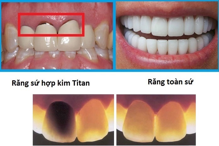 bọc răng sứ vita giá bao nhiêu