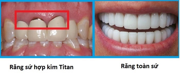 các loại răng sứ vita