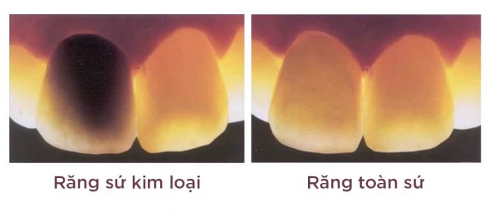 tác hại của bọc răng sứ kim loại