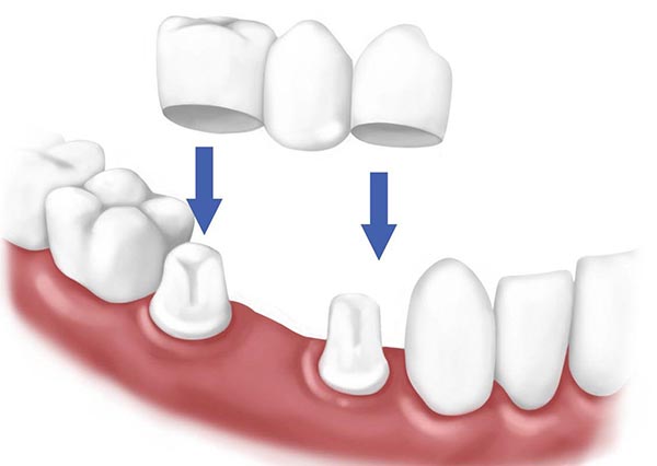 trồng răng khểnh đẹp