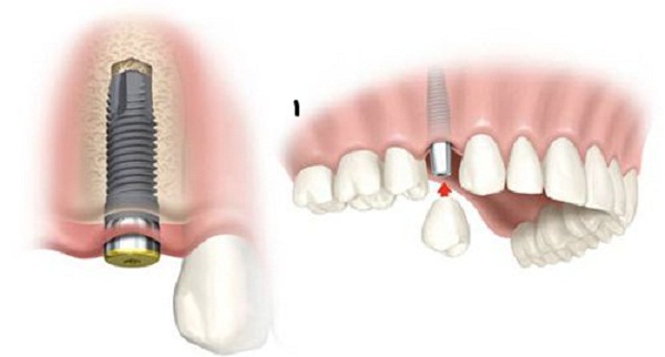 trồng răng khểnh đẹp