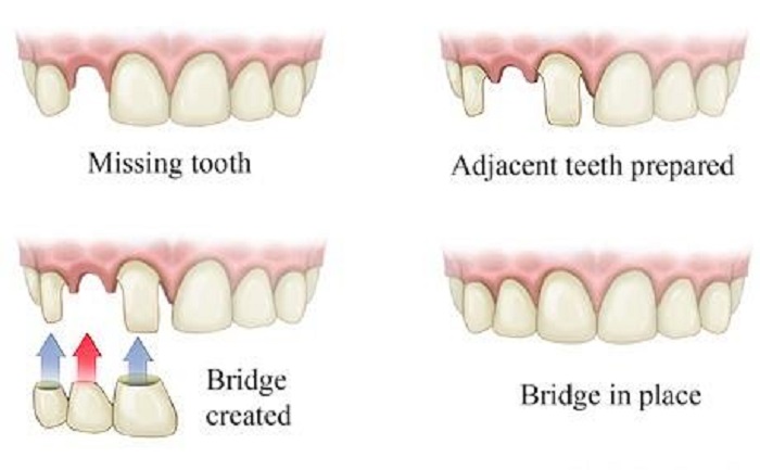 trồng răng khểnh như thế nào