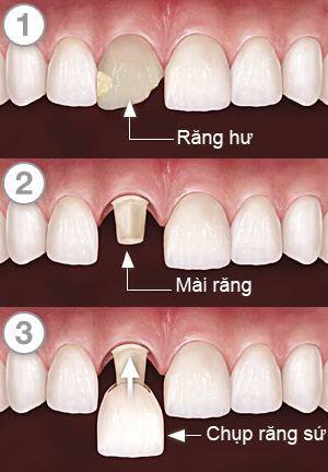 ưu điểm của bọc răng sứ thẩm mỹ