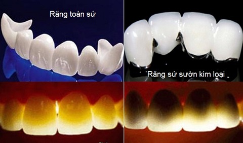 ưu điểm của bọc răng sứ thẩm mỹ