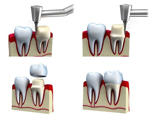 xử lý răng sứ bị hôi như thế nào