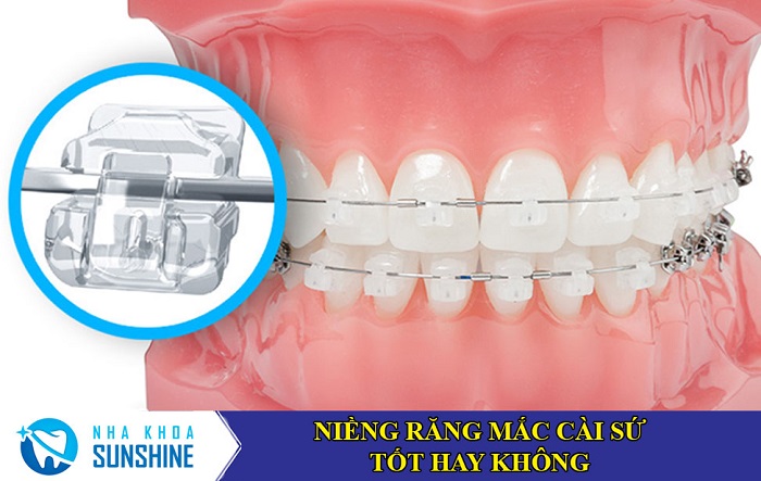 niềng răng cài sứ