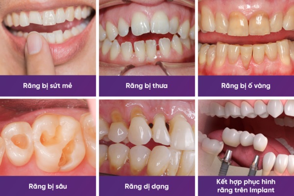 Bọc răng sứ HT Smile