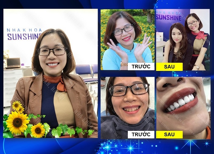 Bọc răng sứ HT Smile