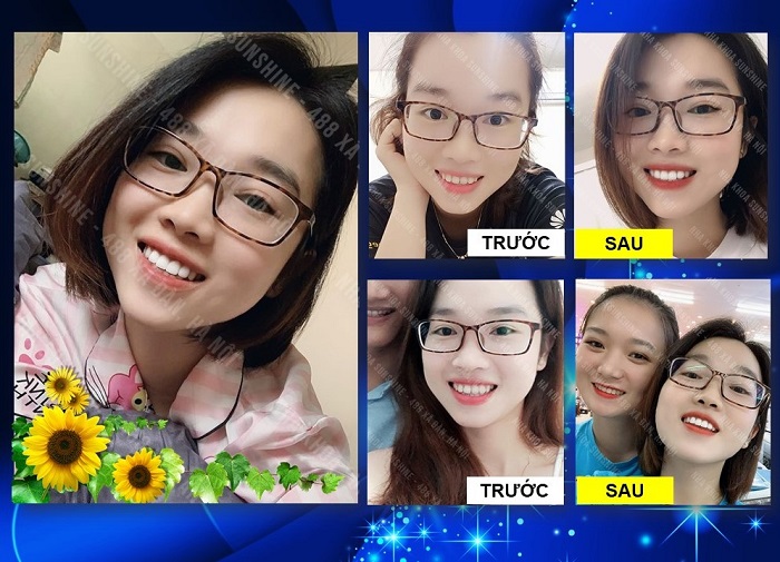 Bọc răng sứ HT Smile