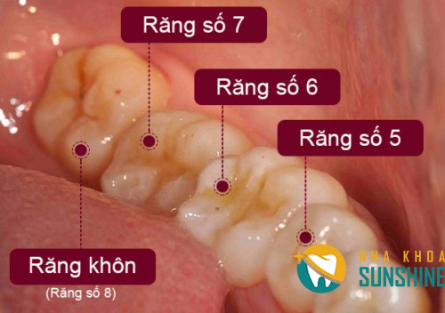 nieng-rang-nen-nho-rang-khon-truoc-hay-sau