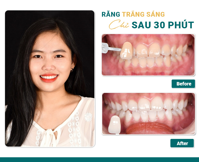 tay-trang-rang-cong-nghe-whitemax4.0