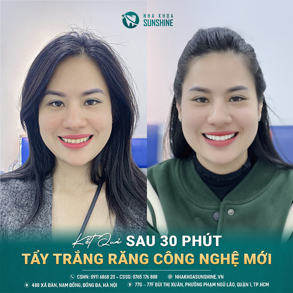 tay-trang-rang-cong-nghe-whitemax4.0-hieu-qua