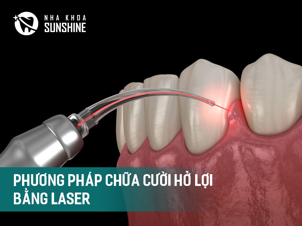 chưa-cuoi-ho-loi-bang-Laser-khong-chay-mau