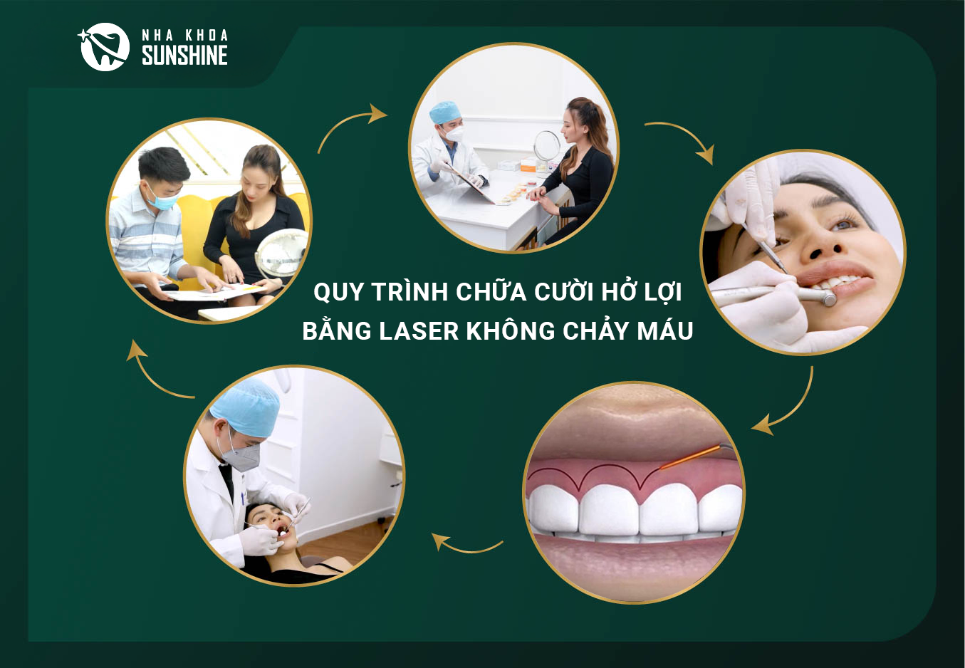 chua-cuoi-ho-loi-bang-laser-khong-chay-mau