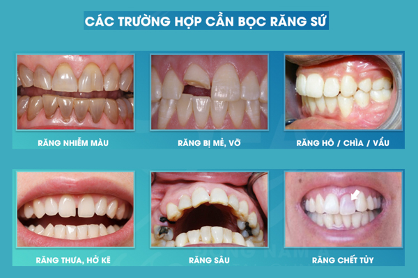 Bọc răng sứ là gì