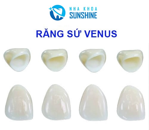 có nên làm răng sứ venus